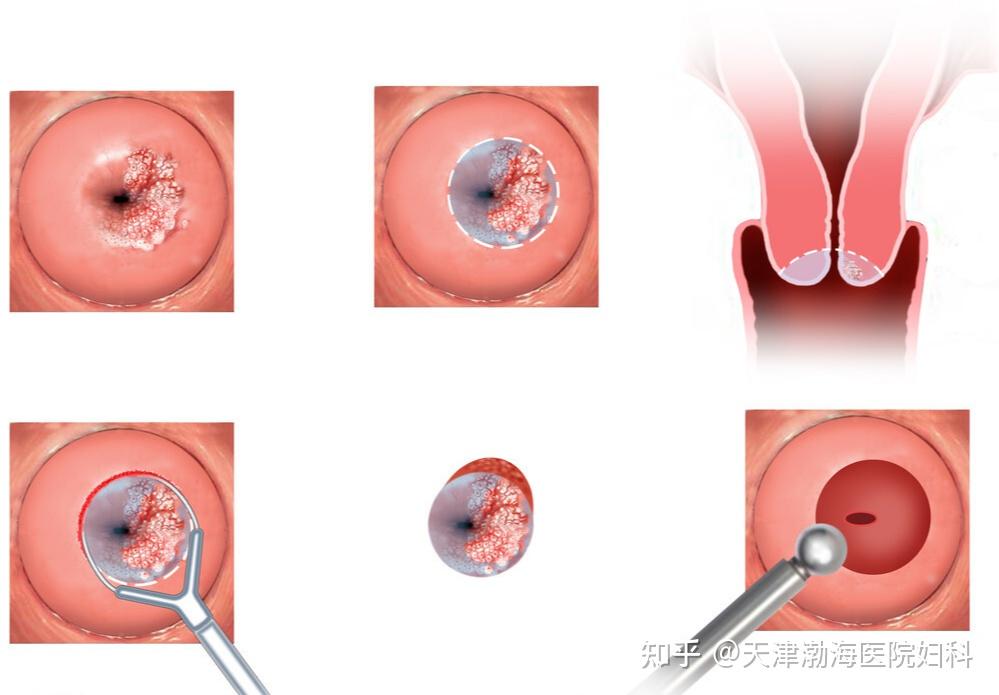 请问慢性宫颈炎如何治疗