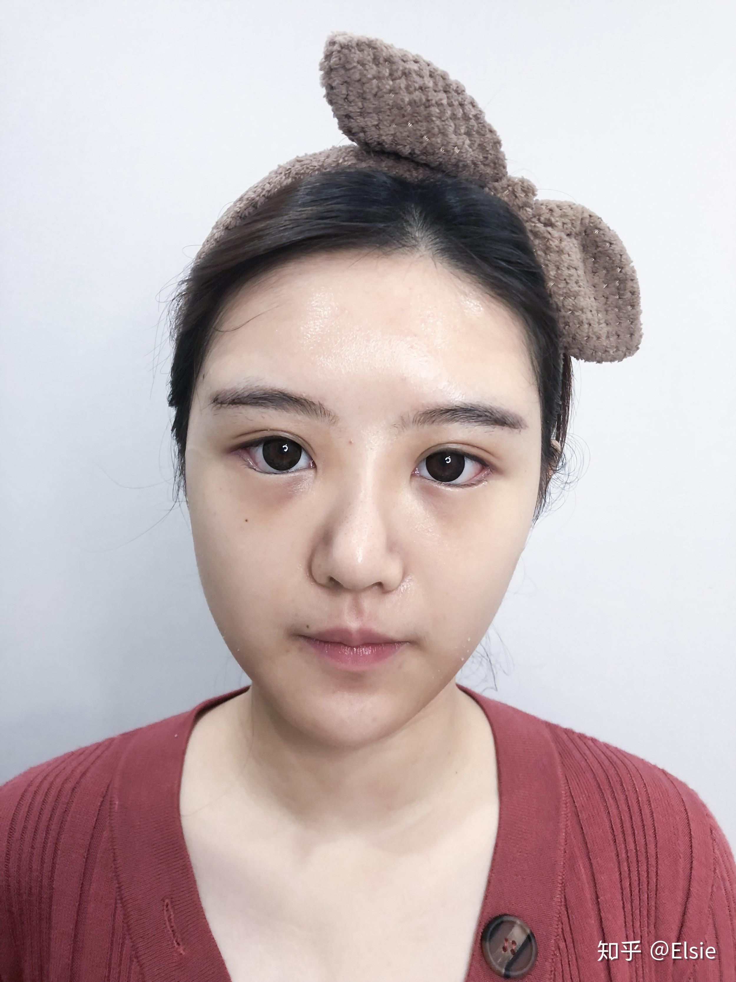 上海丽质美学整形眉弓填充整形真人案例眉弓高好还是低好