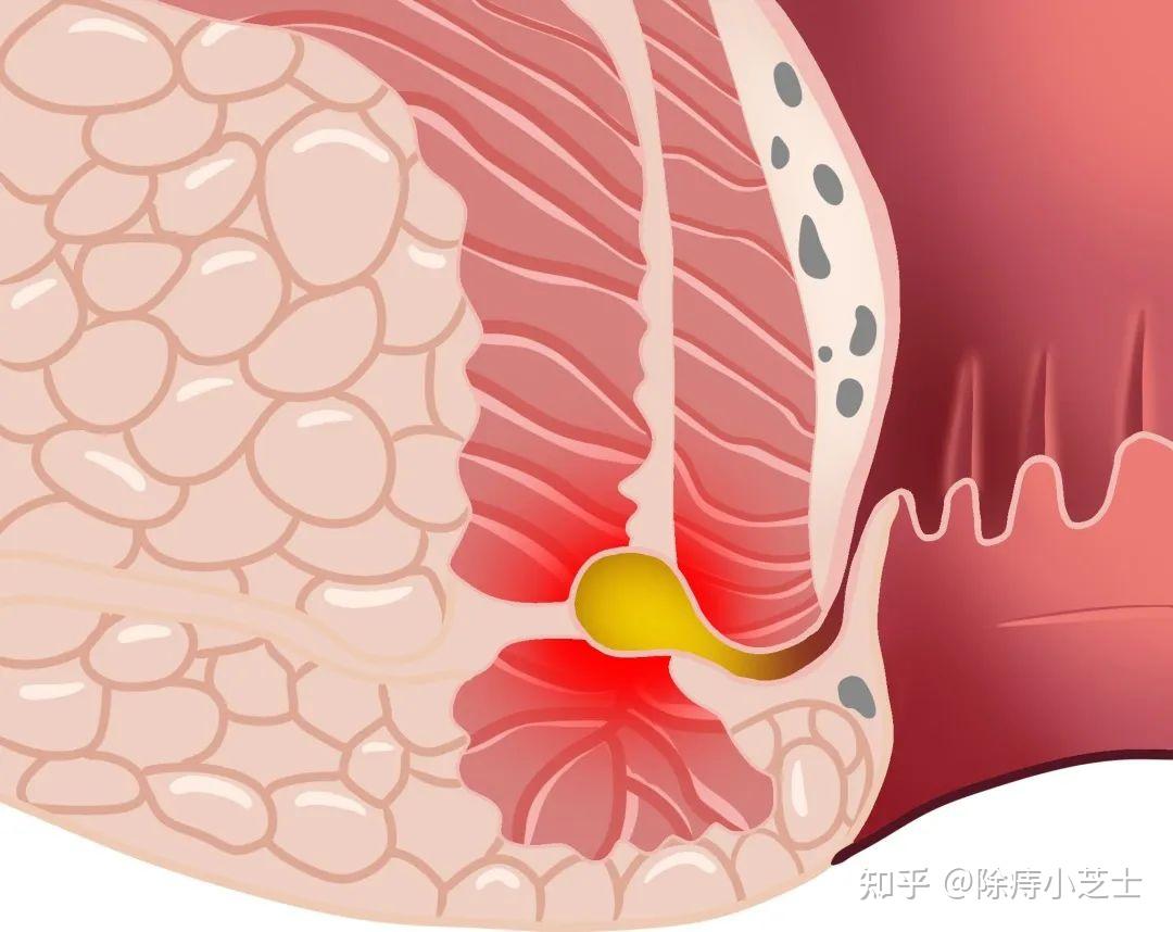 肛瘘一旦形成就无法自愈,及时堵瘘很关键