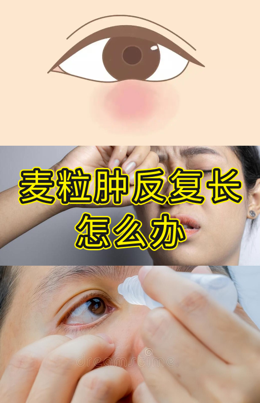 又双叒叕长了麦粒肿？ 眼科大夫教你一次搞定 - 知乎