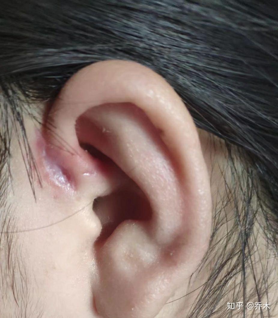 耳朵上隔壁有个小洞,是天生就会这样的,那个小洞有时还会流水出来
