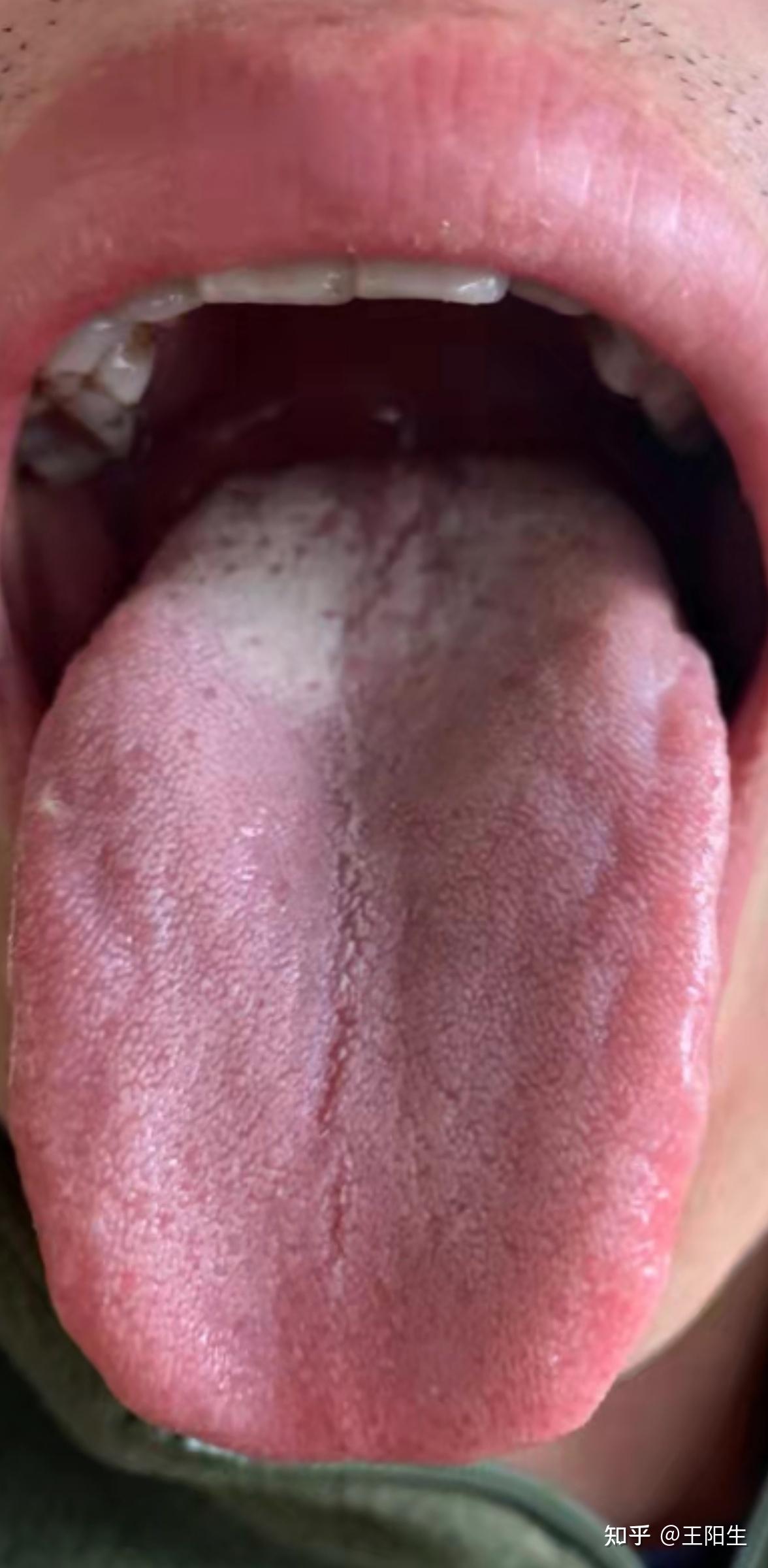 你看他舌头很典型,舌苔都在舌苔根部,越往前面去舌苔越少.