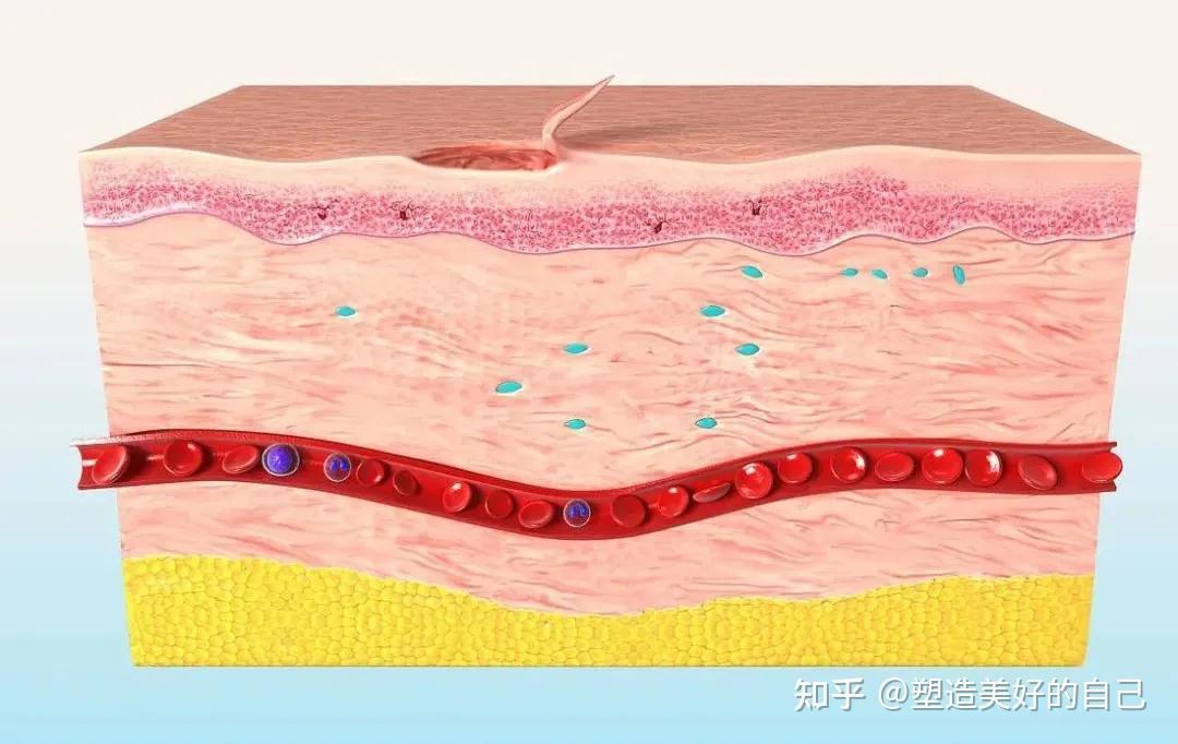 你的伤口为什么出现化脓性感染？ - 知乎