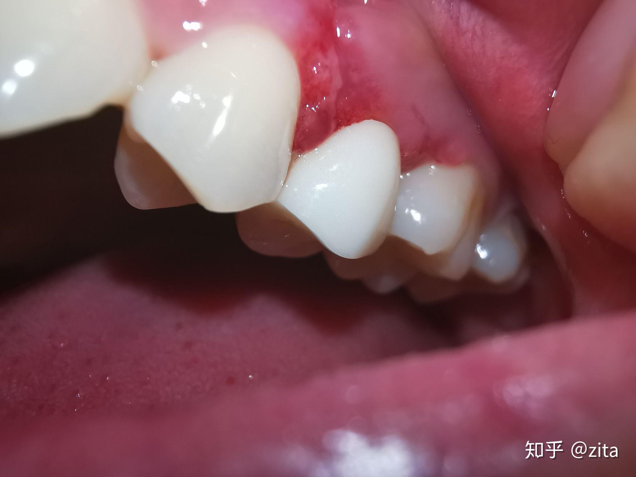 蛀牙的龋坏范围到牙龈下了，手术翻瓣，树脂充填补牙 - 知乎