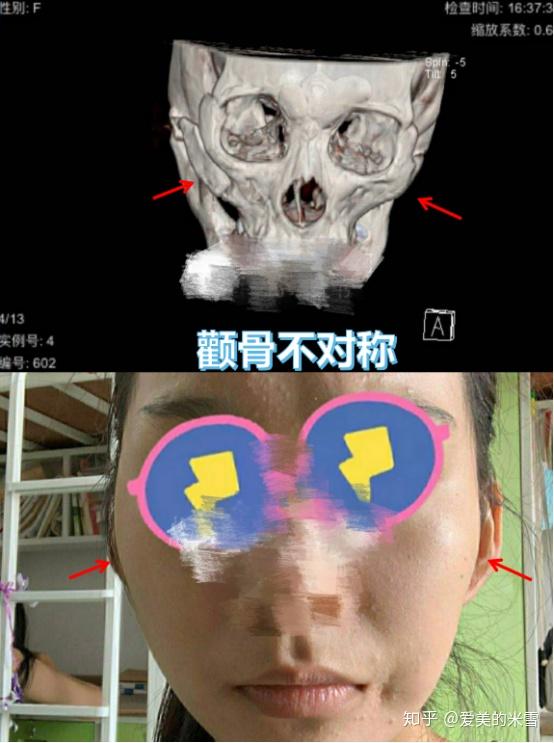削骨手术风险有多大国内削骨医院医生有哪些推荐关于削骨磨骨看这一篇