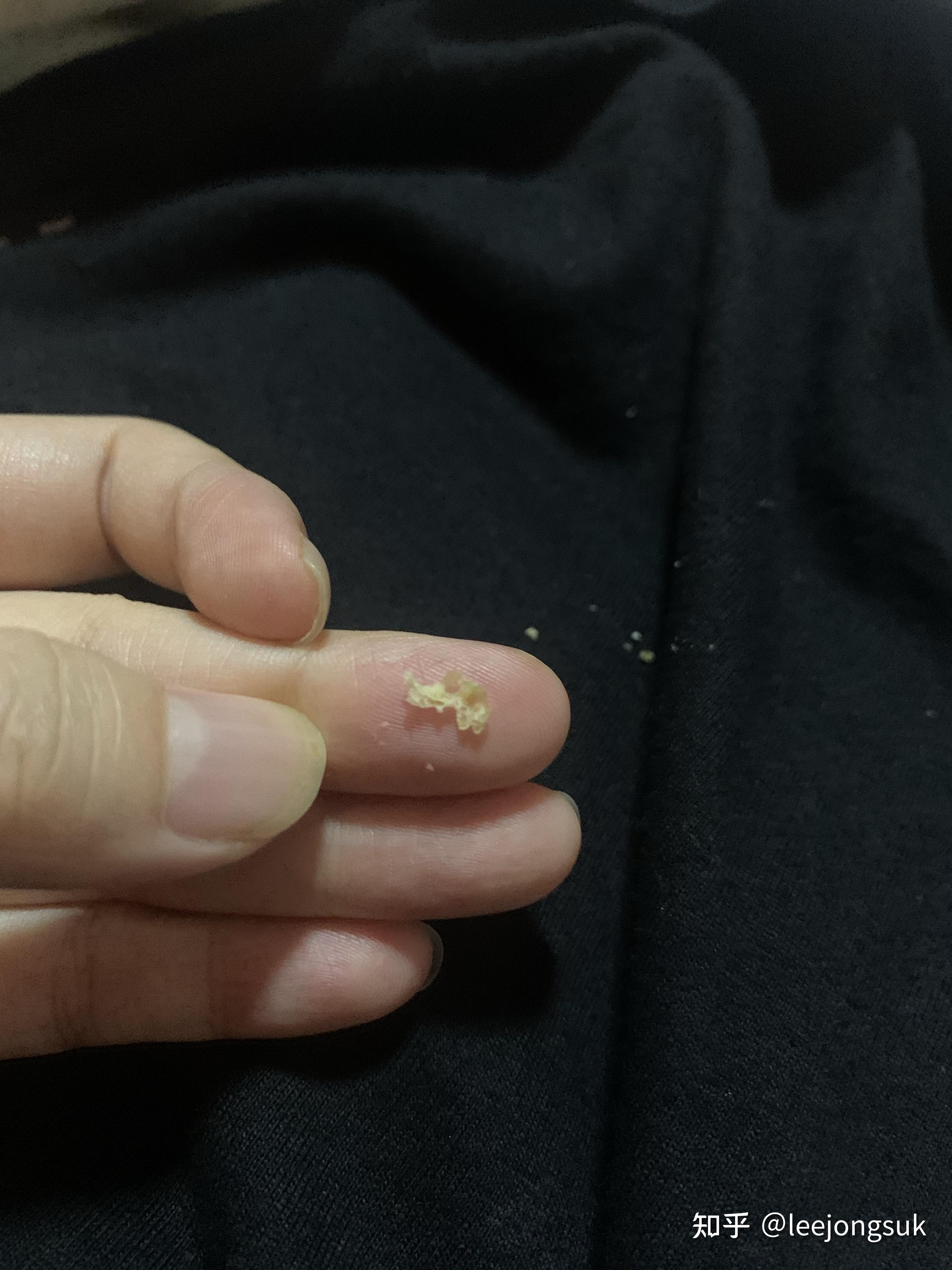 如何把在耳朵深处的耳屎弄出来