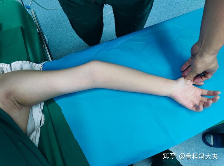 可以明显地看到她的左肘明显的内翻畸形,右肘呈大部分女孩子一样的一