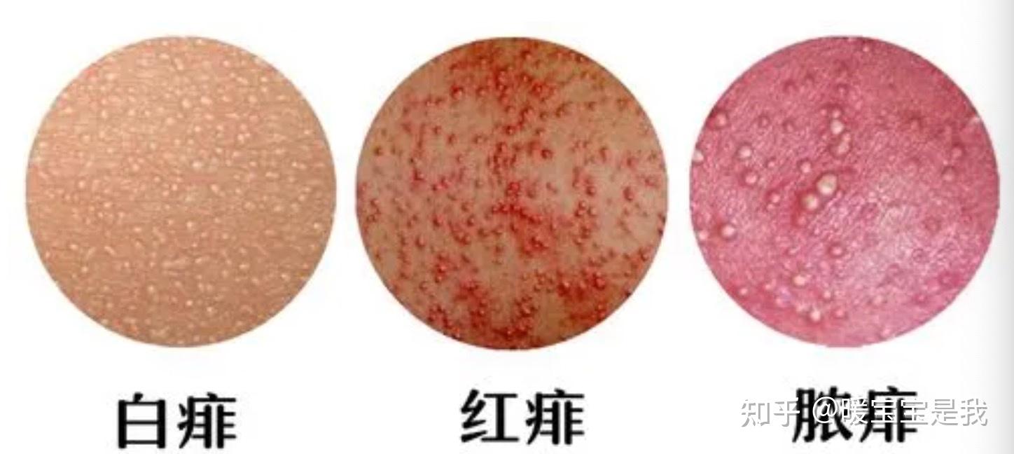 天气转冷了,宝宝还会出热疹吗?宝宝出疹别太大意,对症下药是关键 - 知乎