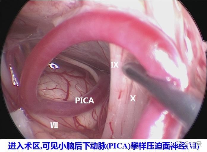 面神经减压手术图片