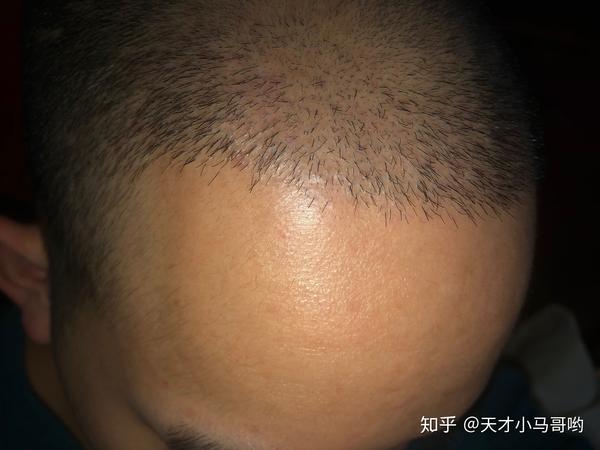 植发后还会脱吗 - 知乎