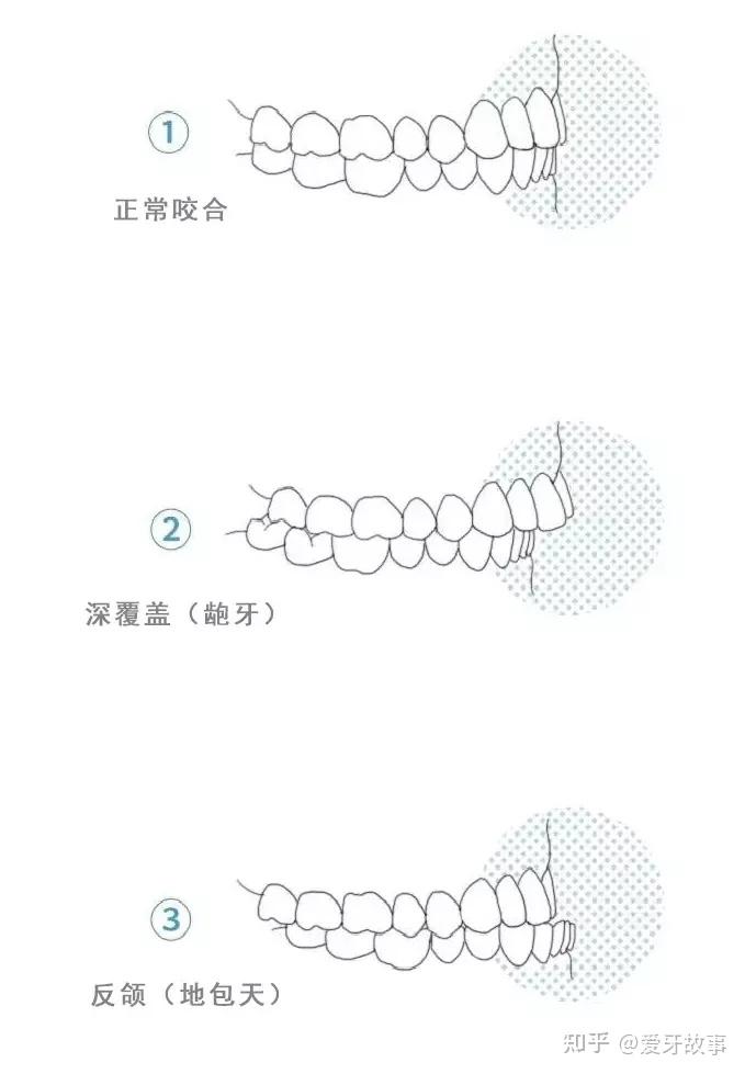 咬紧牙,看咬合