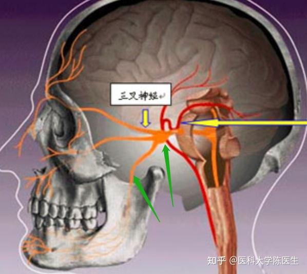 三叉神经疼怎么治 天河仁爱神经外科 - 知乎