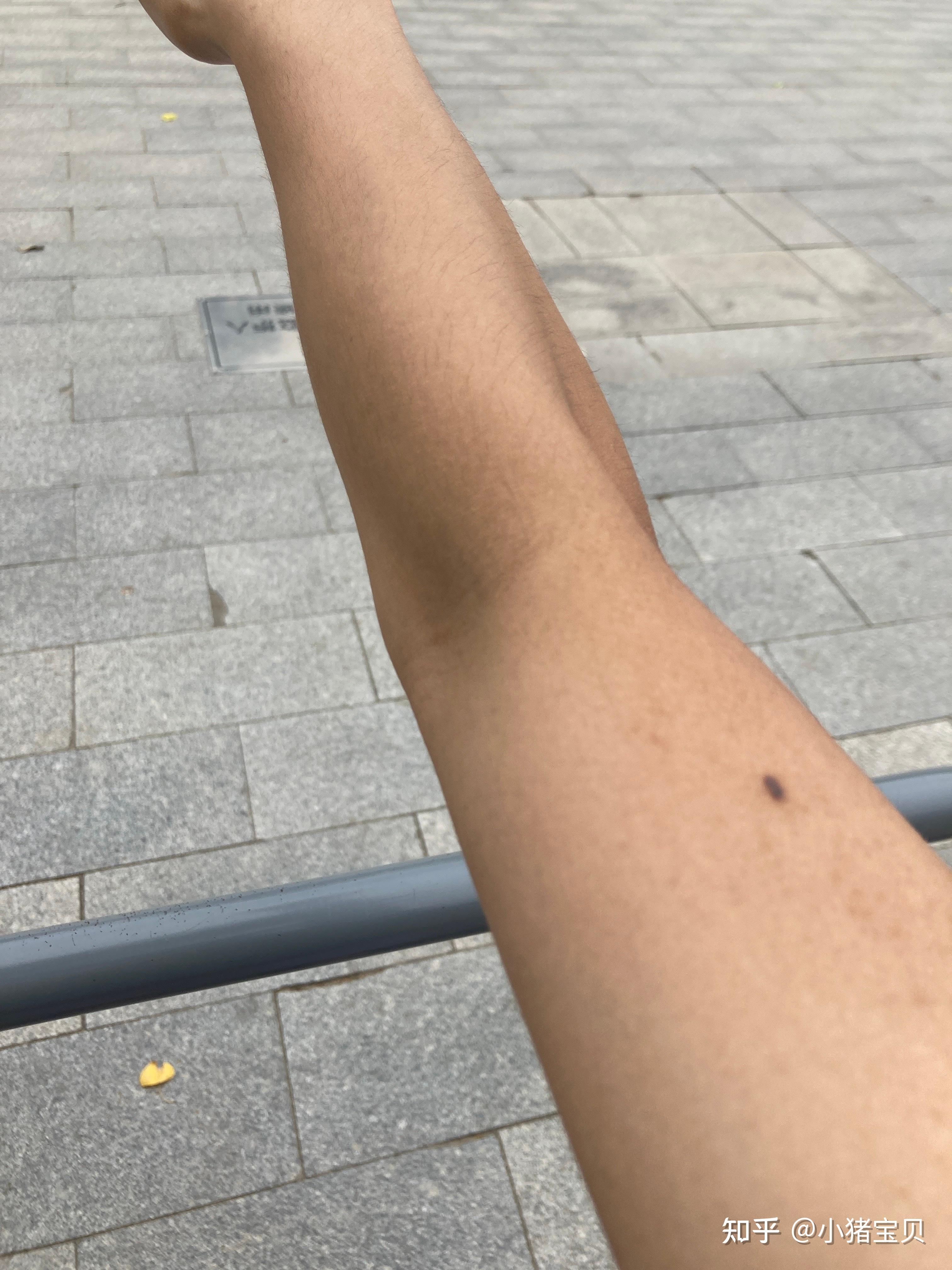 胳膊伸不直,没受过伤? - 知乎