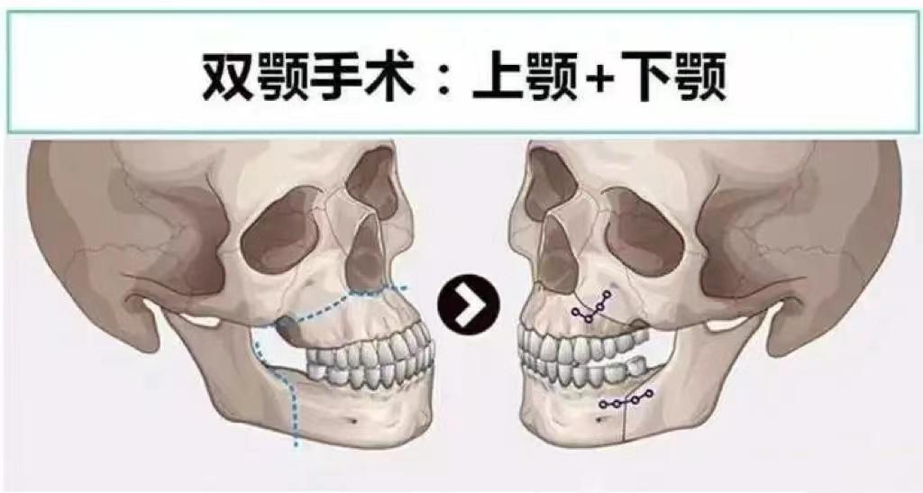 做完正颌手术有后悔吗?后遗症有哪些?