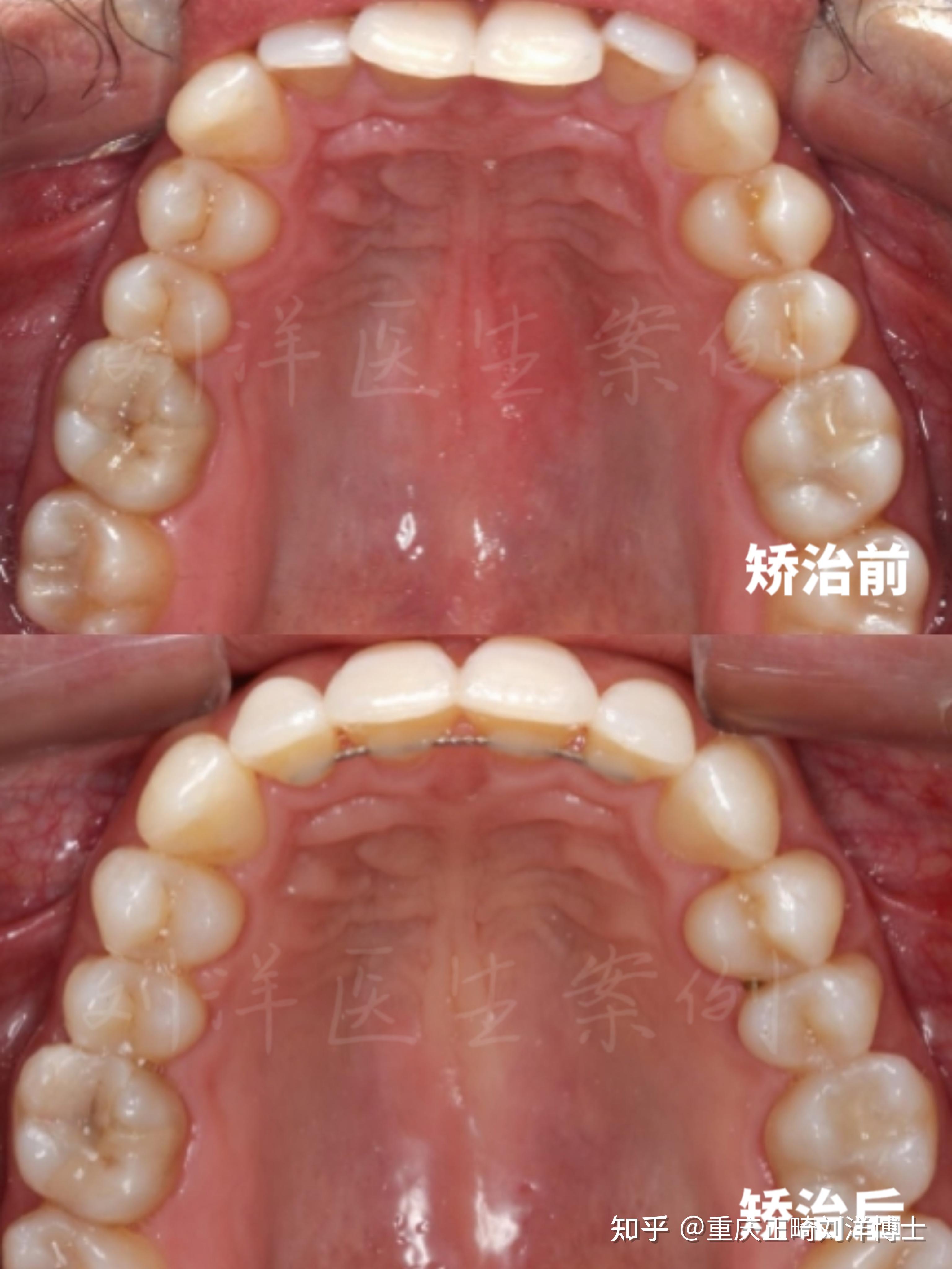 重庆牙齿矫正重庆正畸深覆颌矫正案例分享恢复正常覆颌