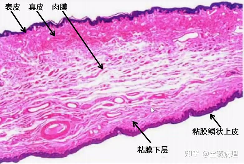 阴茎鳞状细胞癌病理诊断学习笔记 - 知乎