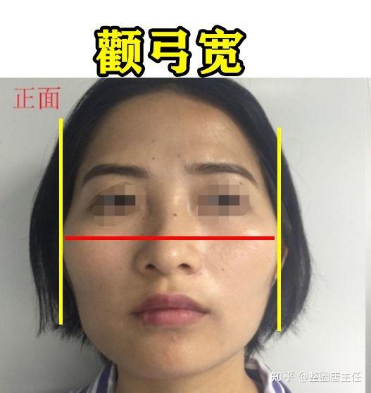 下颌角发育过度就会形成 常见的国字脸,或者梯形脸