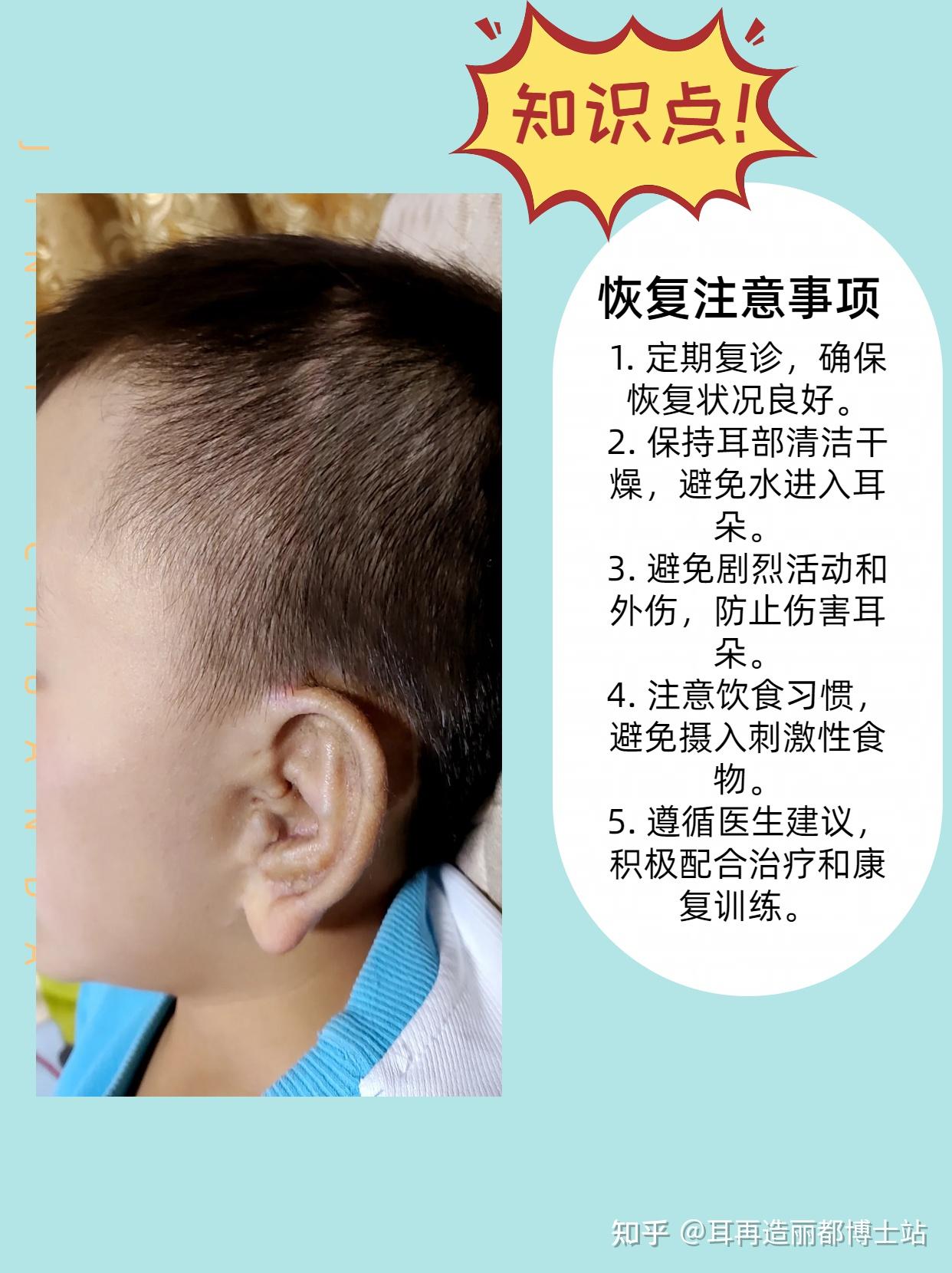 丽格二院安波：广东12岁小婷的小耳畸形矫正之旅 - 知乎