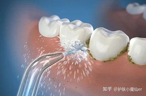 有人用水牙线吗?可以每天用吗?会不会太频繁对牙龈不好?