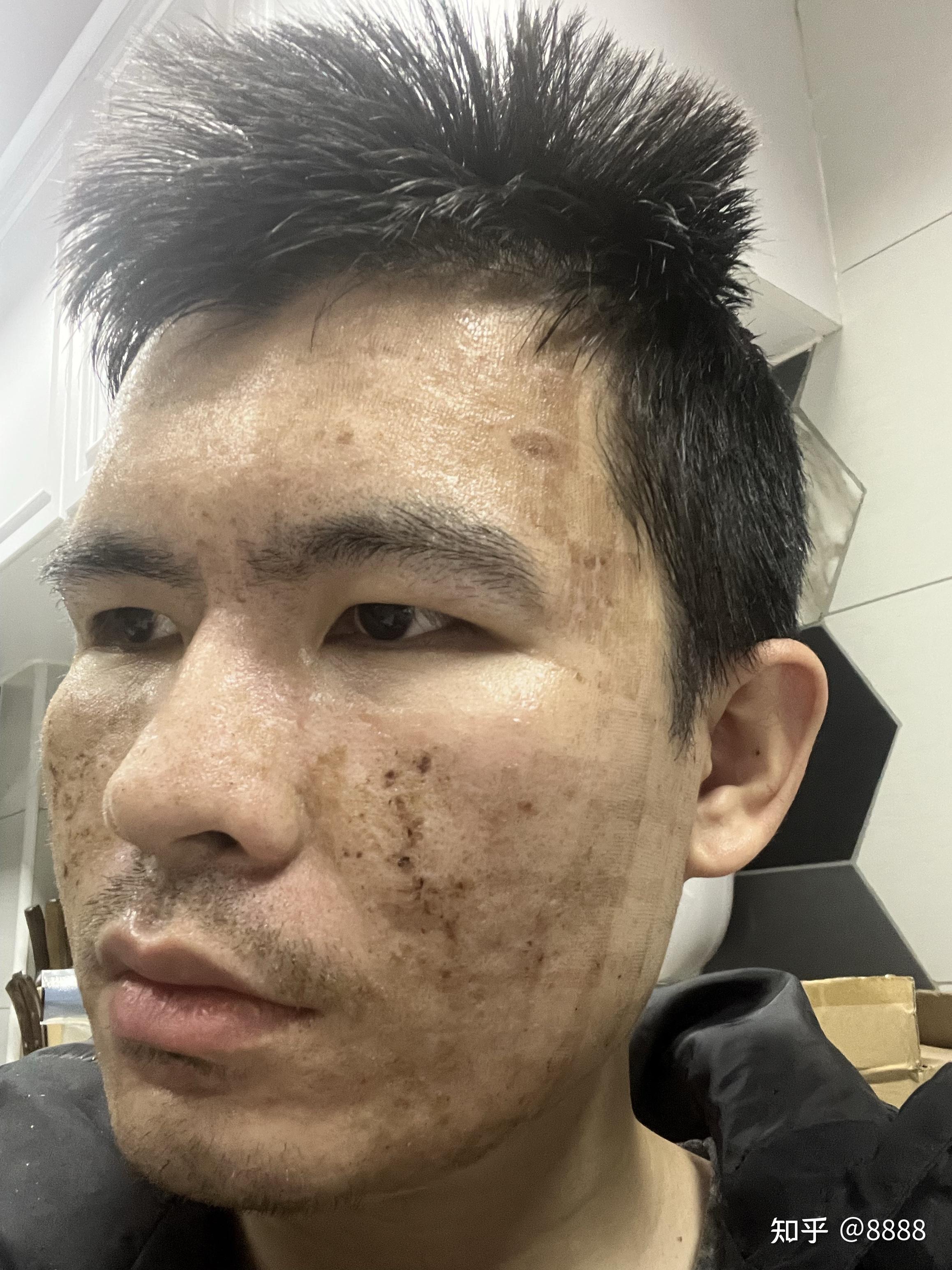 点阵激光第六天