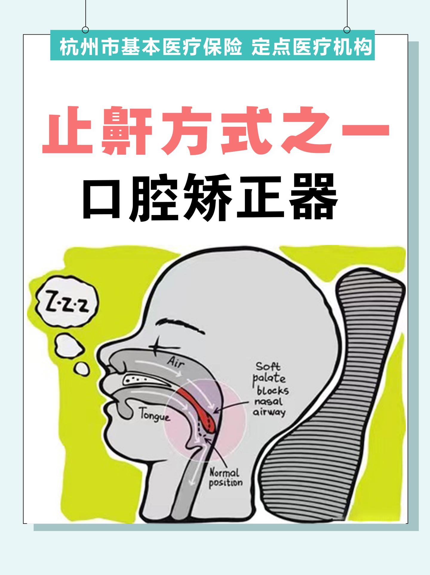 口腔矫正器:主流的止鼾方式之一 - 知乎