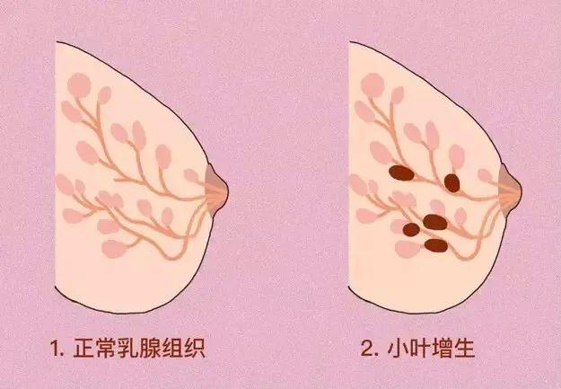乳腺结节图片结构图图片