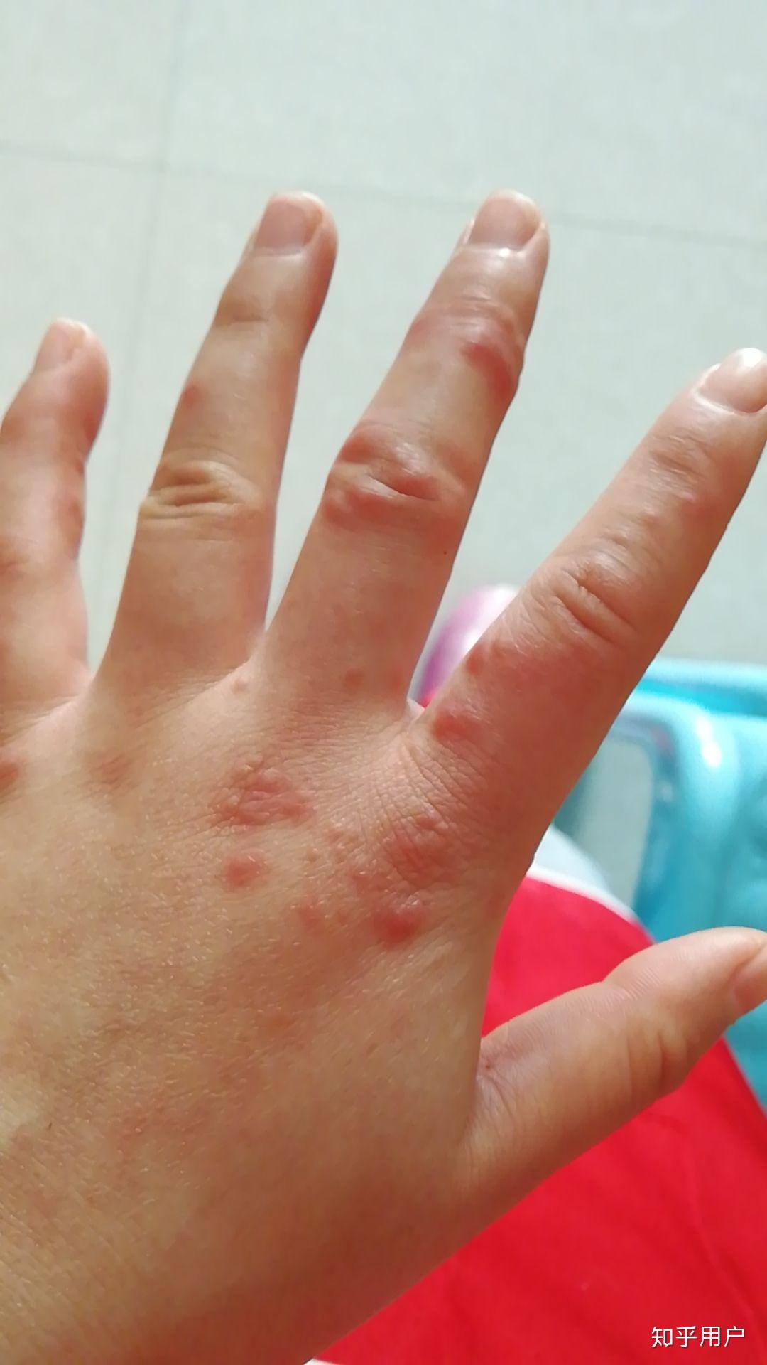 一双10多年的冻疮手好难看