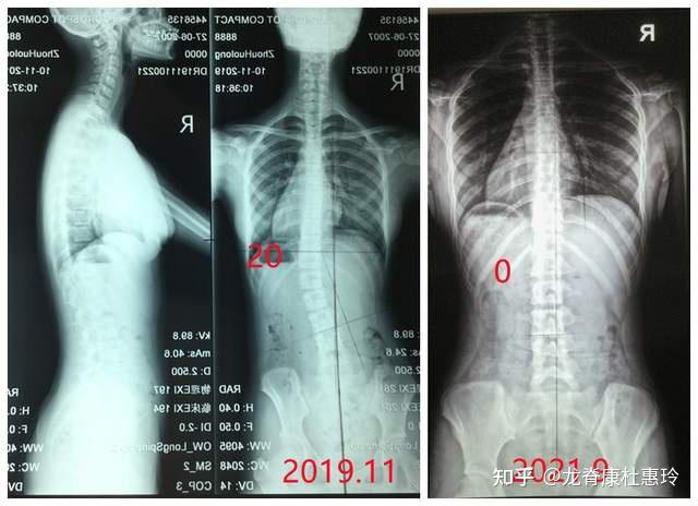 脊柱侧弯佩戴支具后矫形效果究竟怎么样
