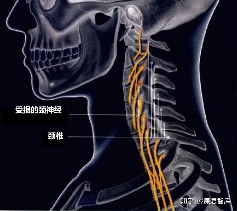 颈部神经损伤全解析 - 知乎