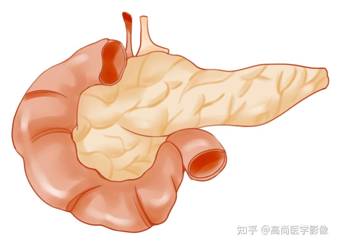 腹胀、恶心、呕吐有可能是急性胰腺炎【高尚医学影像】 - 知乎