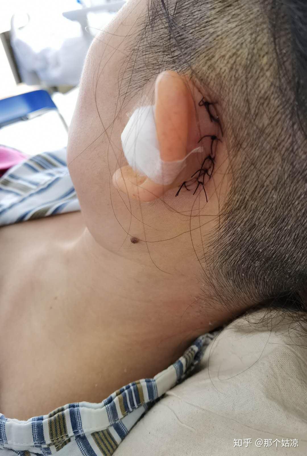 做过外耳道胆脂瘤或中耳胆脂瘤手术的人现在都怎么样了? - 知乎