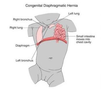 膈肌升高 diaphragmatic elevation