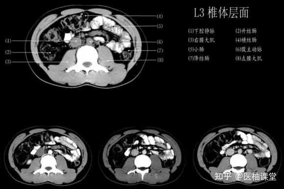 【经典】1小时读懂腹部CT - 知乎