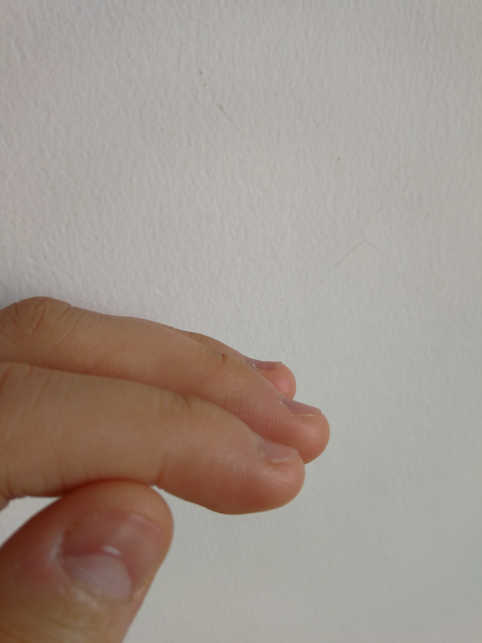 手指甲被咬的超级短怎么办?