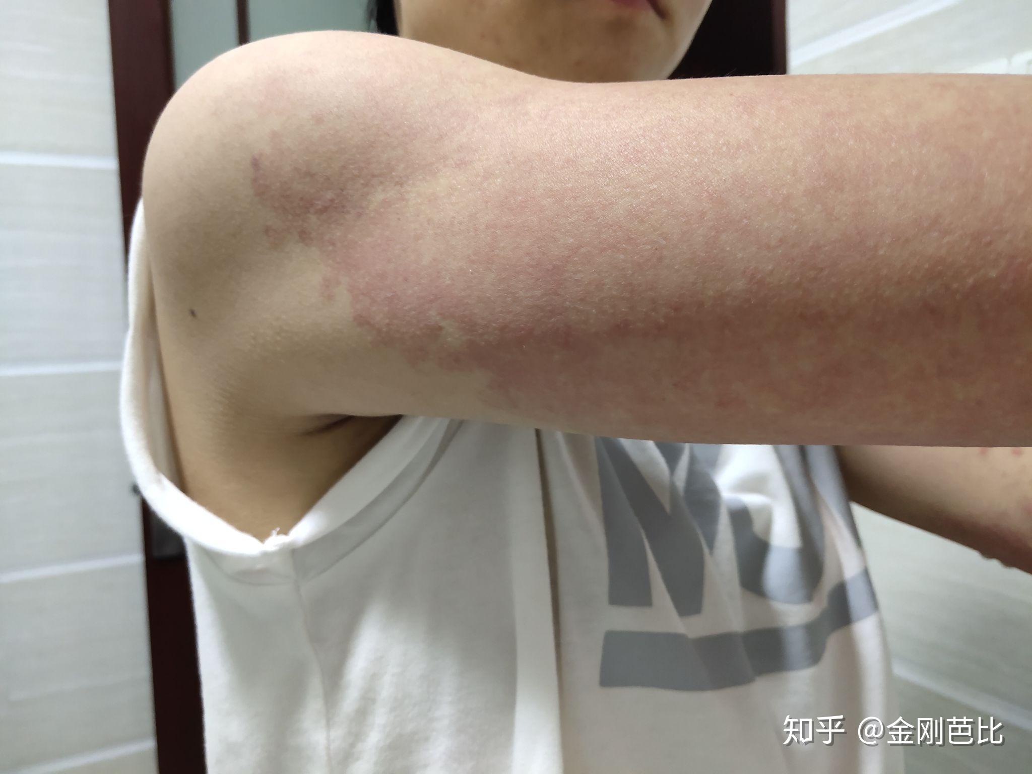 得了多形性红斑,怎么才能痊愈啊?要忌什么吗? - 知乎