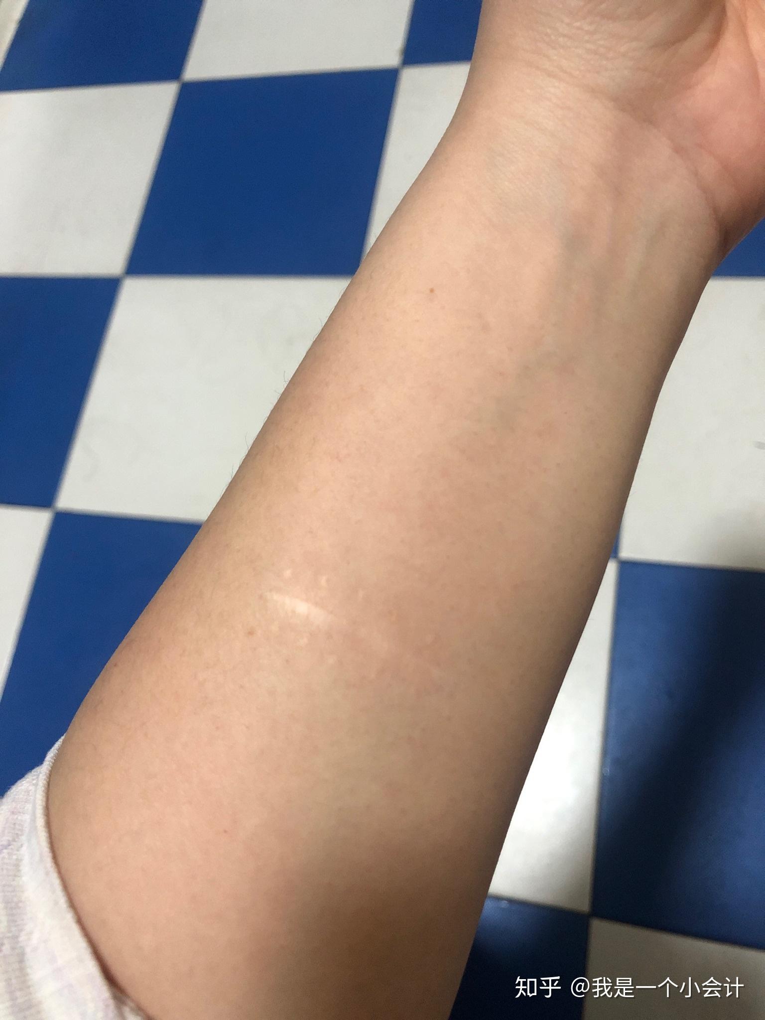 我胳膊有2条疤大概2厘米长凸出来的用喜疗疤可以去掉吗或者激光植皮