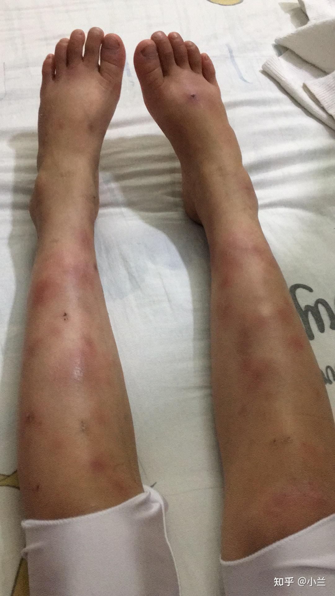 治疗结节性红斑的历程