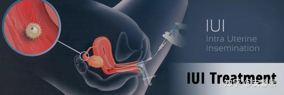 人工授精技术应该得到重视