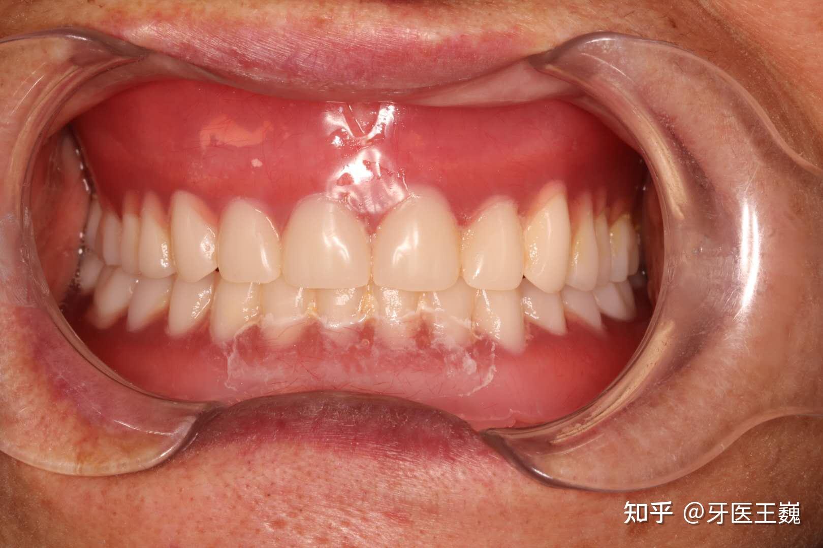 活动假牙多久换一次?需要注意什么?