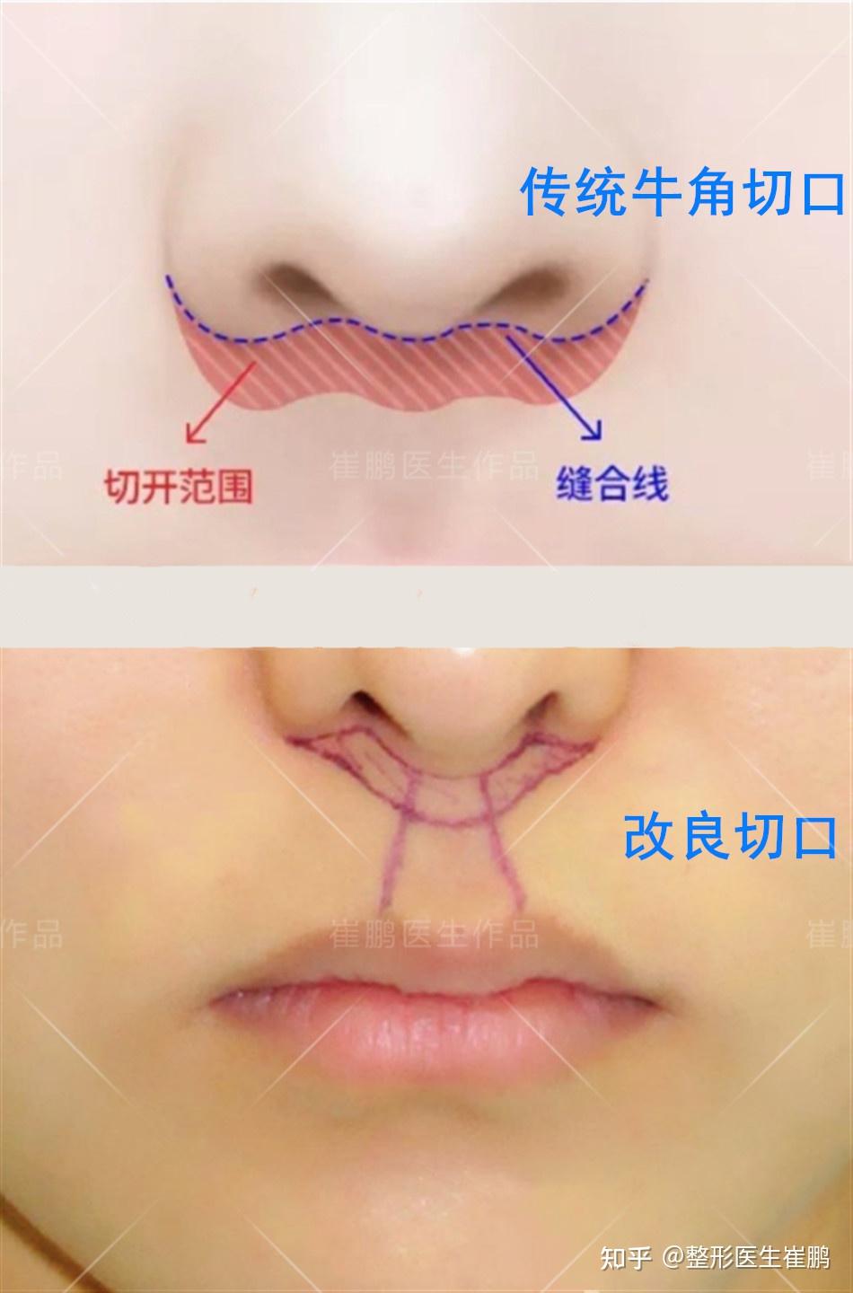 人中加深手术过程图片图片