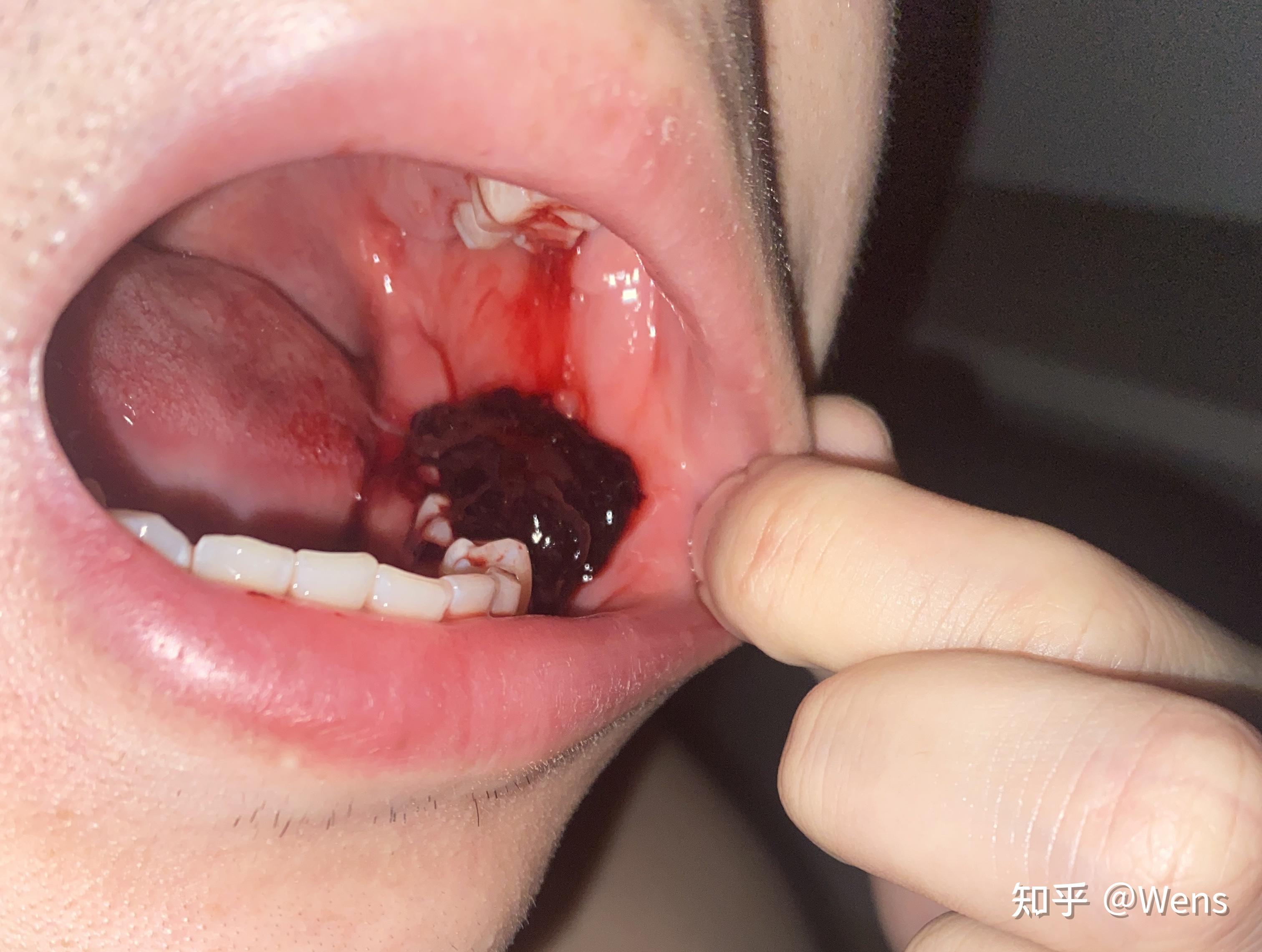 拔牙后血凝块特别大要去医院吗? - 知乎