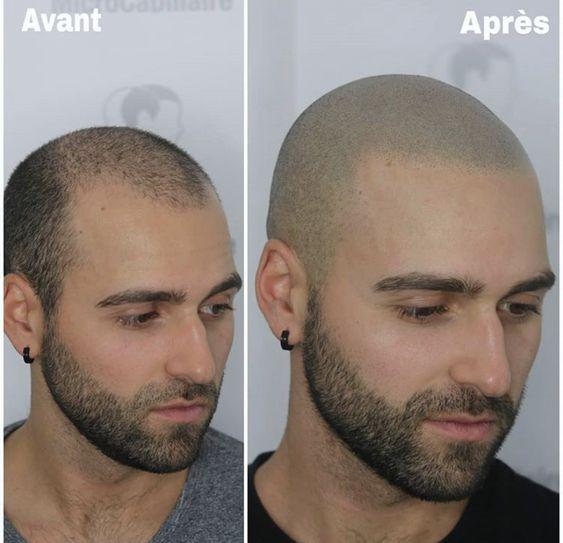 头发稀疏的男士选择光头之后,也要定期的修剪,否则新生发长出来也会