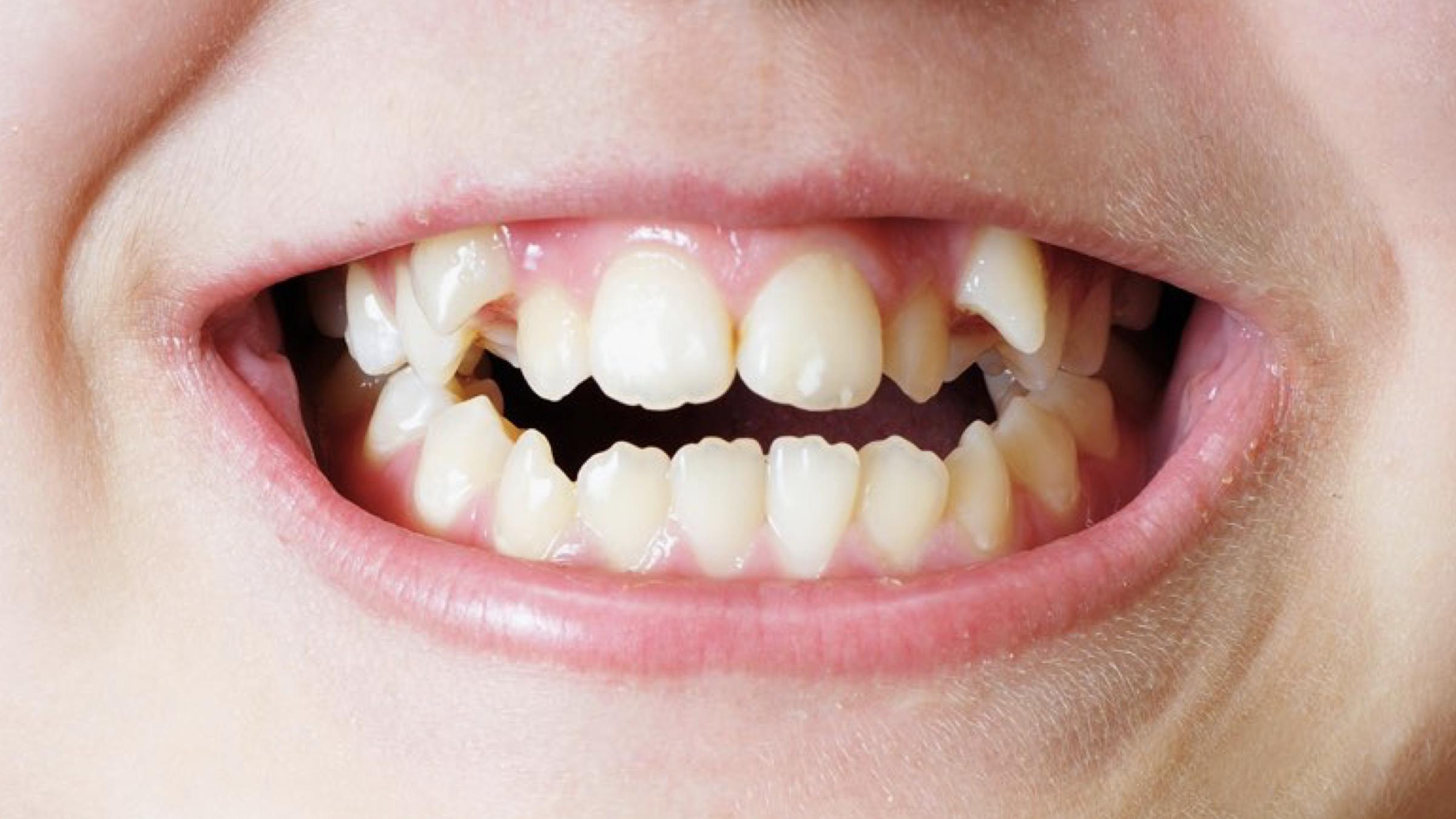 矫正牙齿到底可以改变什么？