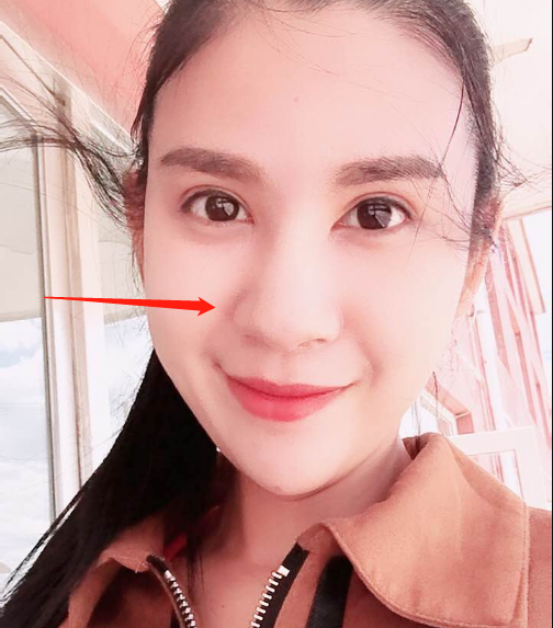 北京硅胶鼻综合大鼻头缩小术后分享10980