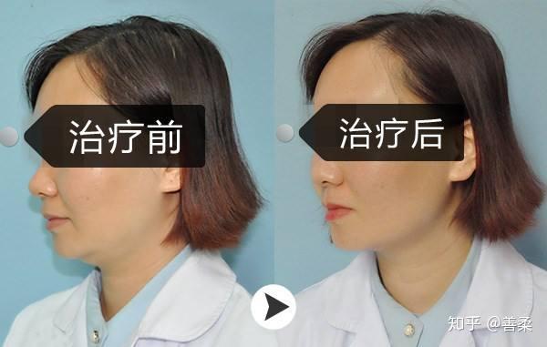 超声刀副作用超声刀美容太可怕了