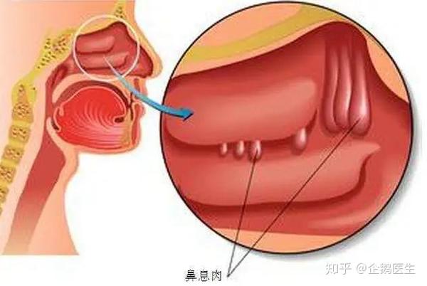 惊 宝宝鼻子里长出一块肉 这件小事不干预小心会后患无穷 知乎