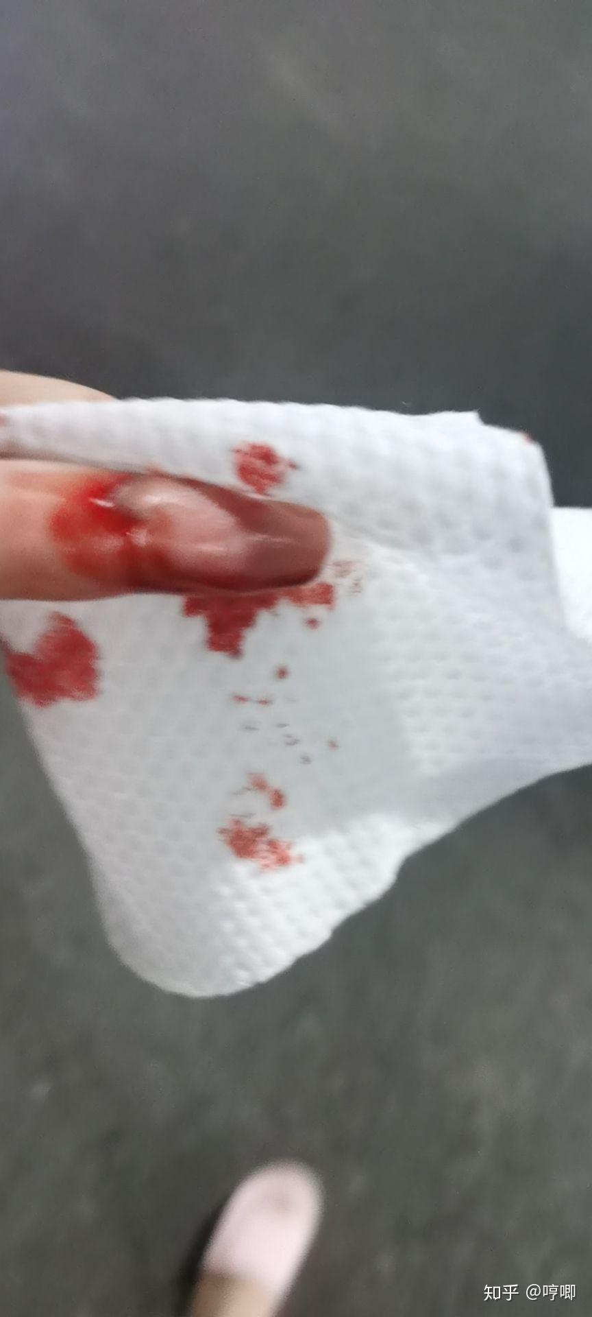 切菜切到手该怎么办