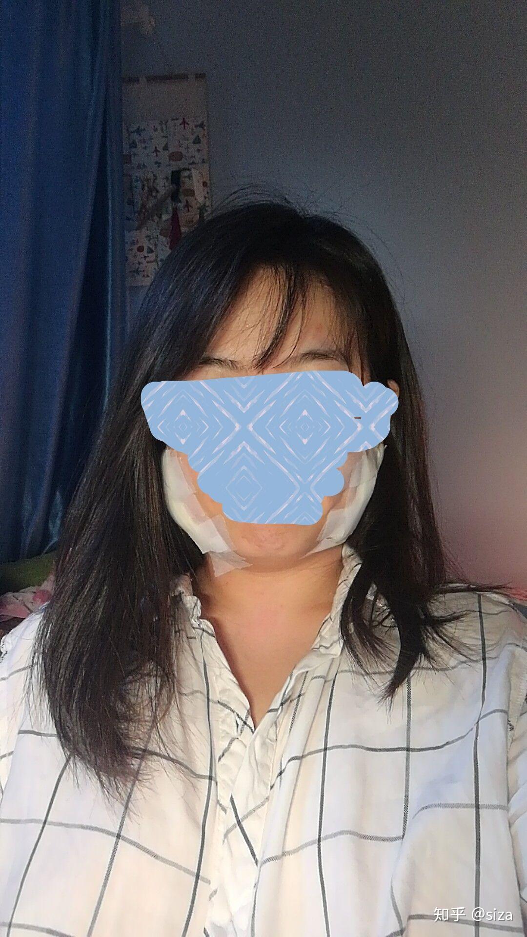 成年人得腮腺炎是一种怎么样的体验? - 知乎