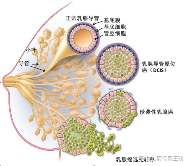 乳腺增生的五个阶段