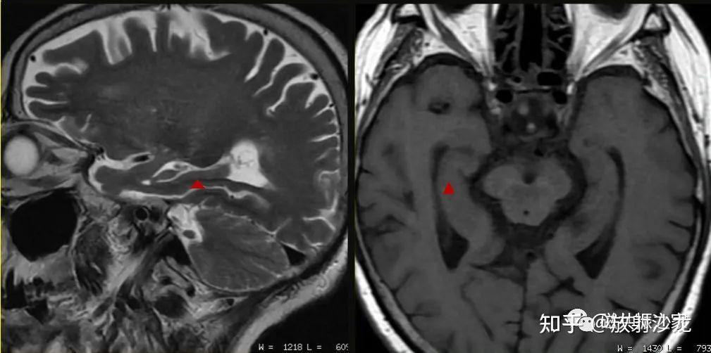 扫盲海马mri该如何扫描